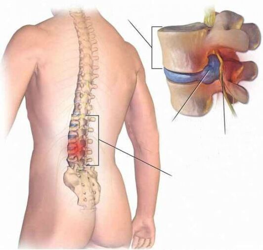Intervertebralna kila